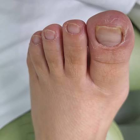 Excesso de pele ao redor das unhas