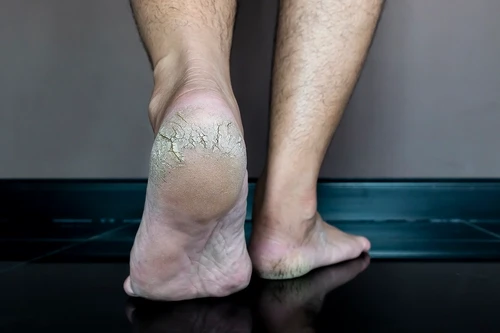 Fissuras nos pés